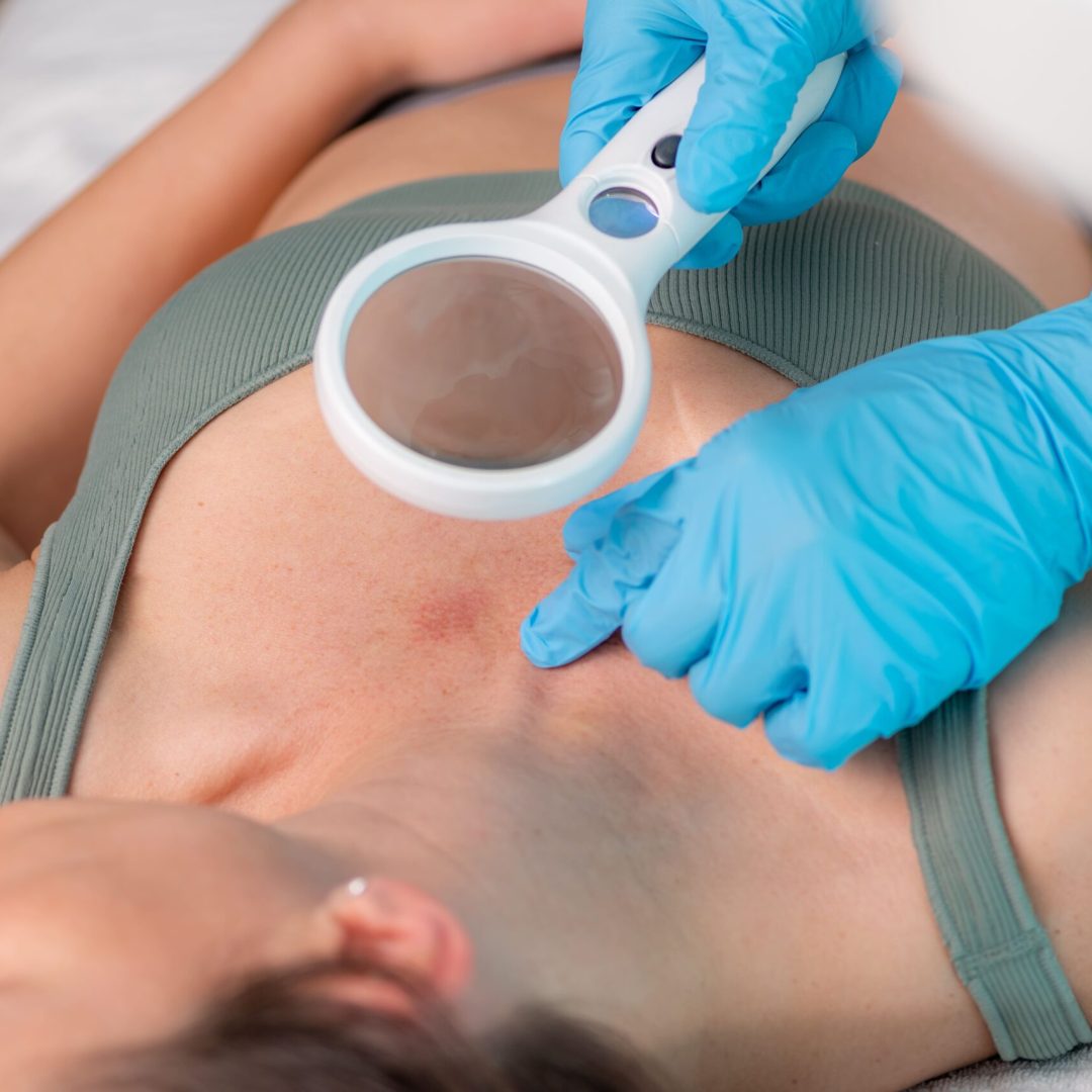 Remocion laser (2)